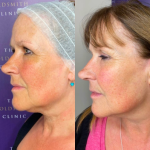 before after Morpheus8