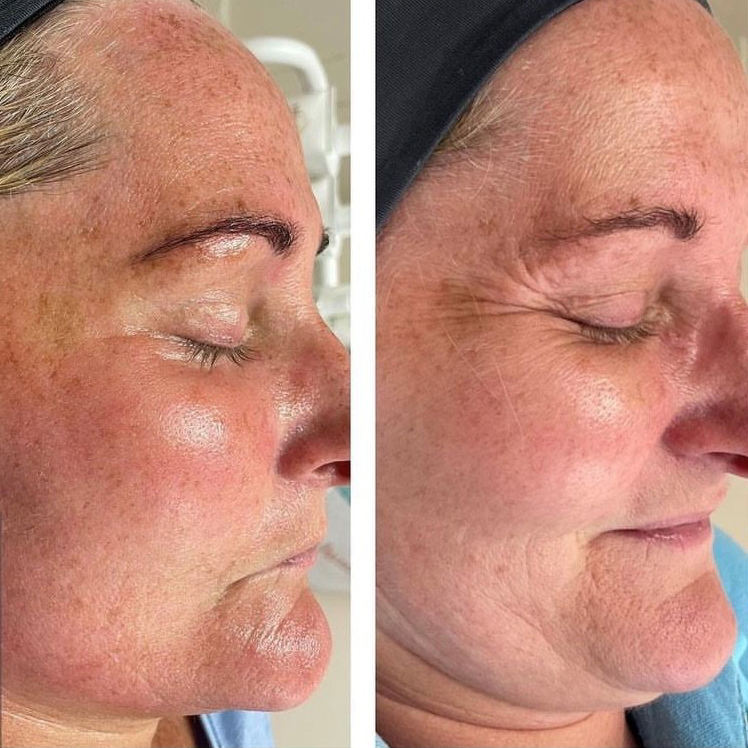 Before and After Lines Microneedling