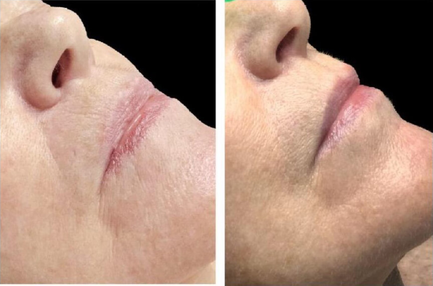 Celluma Before - After