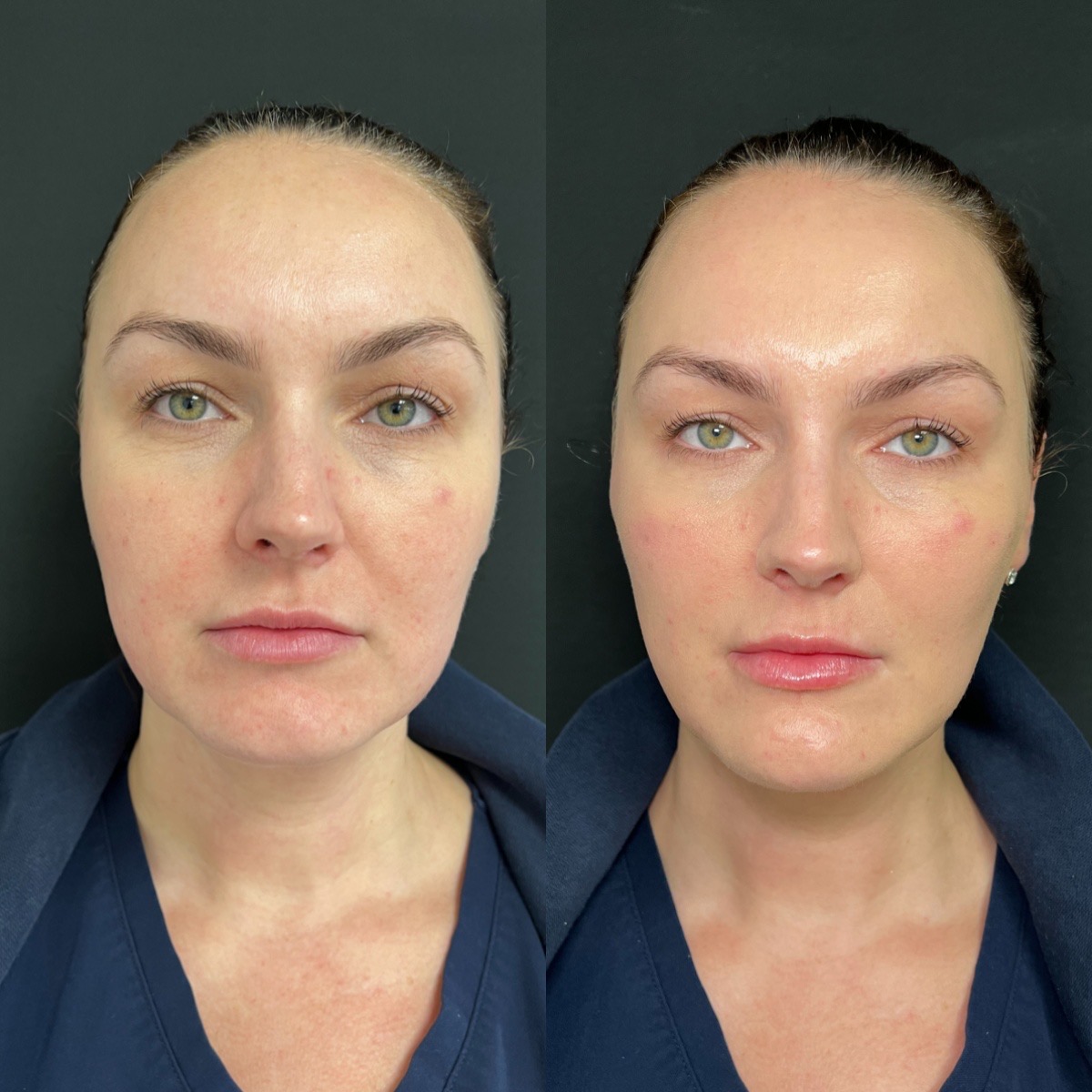 Dermal Fillers