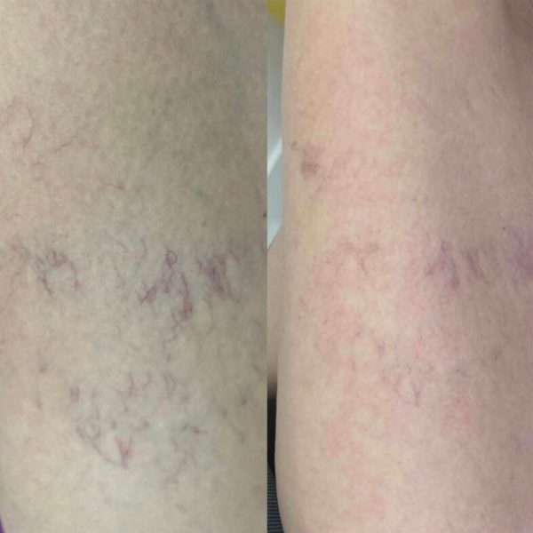Microsclerotherapy Thread Veins-Microsclerotherapy | The Goldsmith Clinic