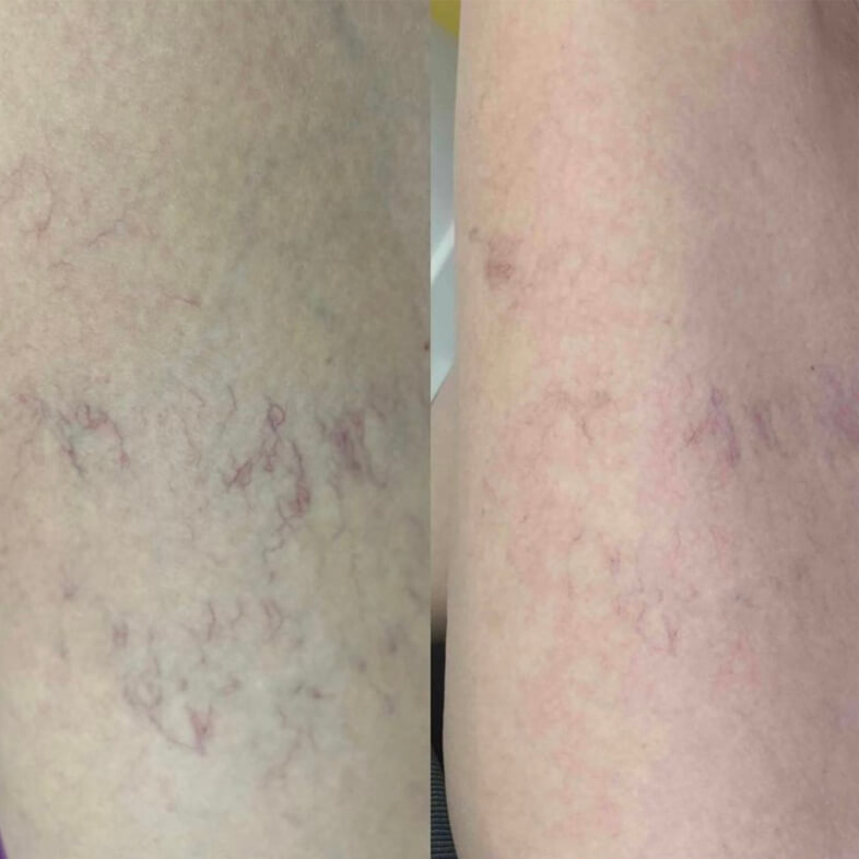 microsclertherapy before - after